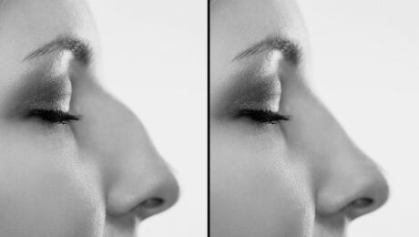 kemerli burun estetik ameliyatı