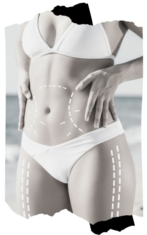 vaser liposuction operasyonu