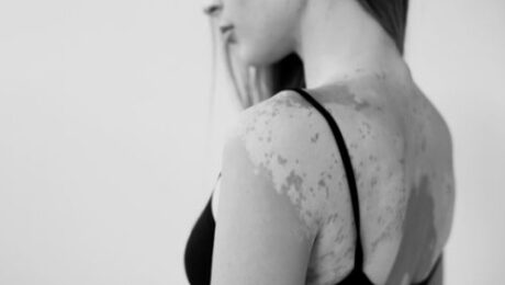 vitiligo nedir<div class='yasr-stars-title yasr-rater-stars-vv'
id='yasr-visitor-votes-readonly-rater-ab129ae966b64'
data-rating='3.8'
data-rater-starsize='16'
data-rater-postid='19263'
data-rater-readonly='true'
data-readonly-attribute='true'
data-cpt='posts'
></div><span class='yasr-stars-title-average'>3.8 (4)</span> vitiligo nedir