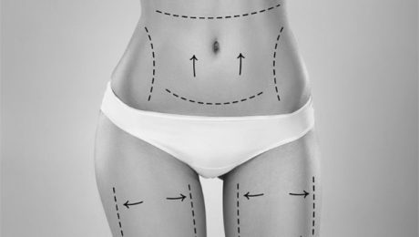 Liposuction Ne İşe Yarar<div class='yasr-stars-title yasr-rater-stars-vv'
id='yasr-visitor-votes-readonly-rater-1d6d54afcb1af'
data-rating='0'
data-rater-starsize='16'
data-rater-postid='21167'
data-rater-readonly='true'
data-readonly-attribute='true'
data-cpt='posts'
></div><span class='yasr-stars-title-average'>0 (0)</span> Liposuction Ne İşe Yarar