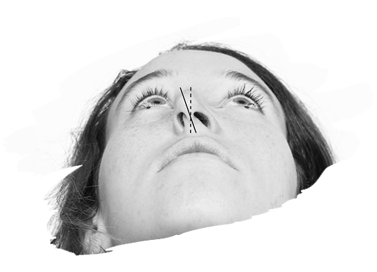 Burun Deliklerini Şekillendirme (Alar Baz Daraltma) Nedir Kimlere Yapılır