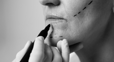 Bişektomi mi, Orta Yüz (Midface) Lift mi Bişektomi mi, Orta Yüz (Midface) Lift mi