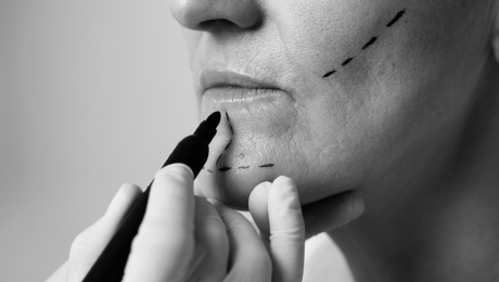 Bişektomi mi, Orta Yüz (Midface) Lift mi