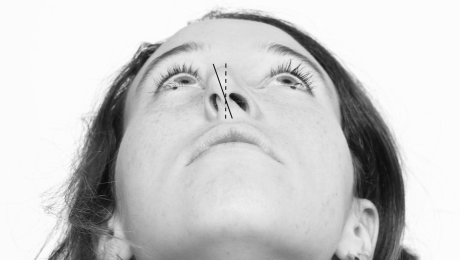 Burun Deliklerini Şekillendirme (Alar Baz Daraltma) Nedir Kimlere Yapılır